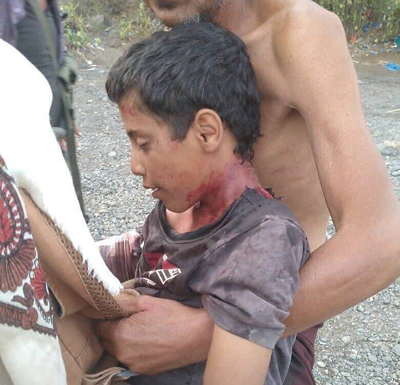 الطفل عدي يُقنص في رقبته من قبل الحوثيين عند تناوله واجبة الافطار جوار منزله