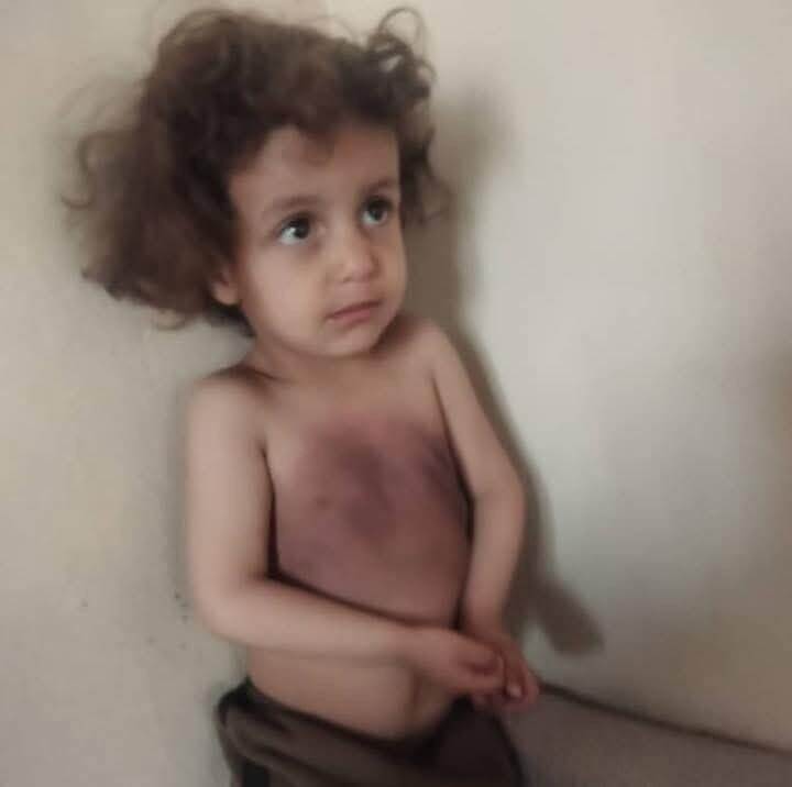 تعذيب مروّع لطفل في يريم على يد اخيه يثير غضب شعبي ومطالبات بعقاب الجناة والمتسترين